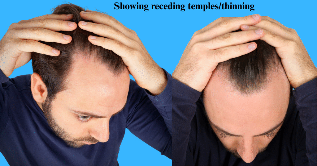 Comparison image showing early receding temples and thinning at the frontal hairline for men, highlighting the onset of male pattern baldness.