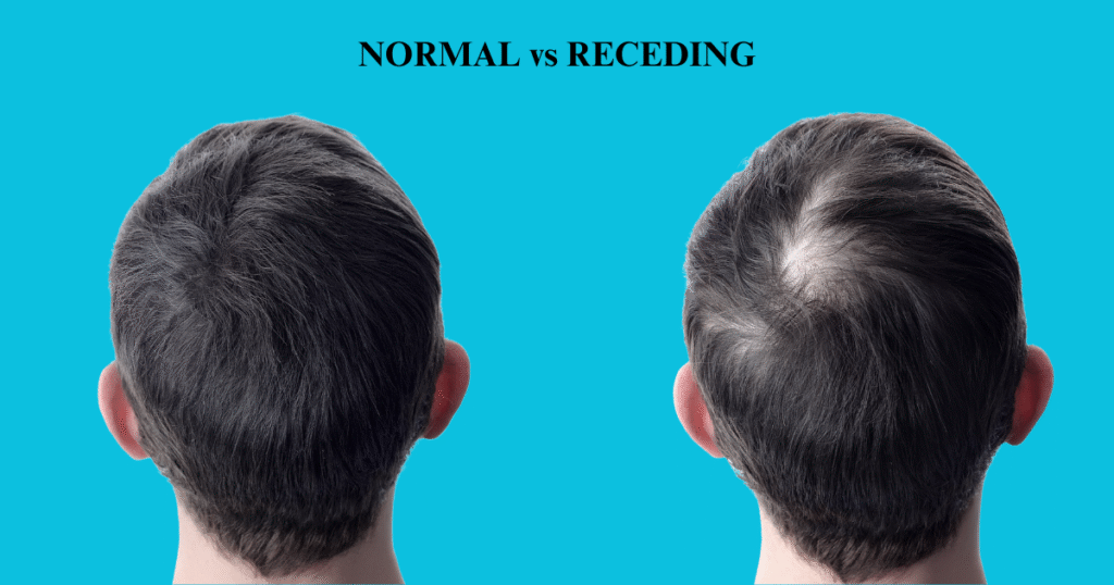 Comparison of Normal vs. Receding Hairline, showing the back of two men's heads to illustrate crown and vertex thinning.