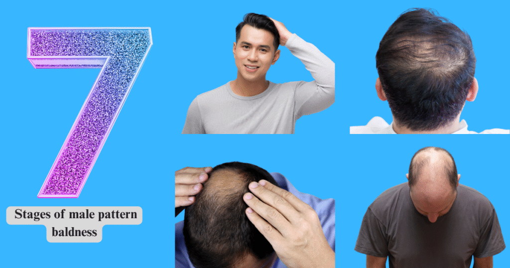 Visual guide to the 7 Stages of Male Pattern Baldness according to the Norwood Scale, showing receding hairline and crown thinning.